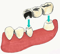 dental bridge for West Haven and Riverdale UT