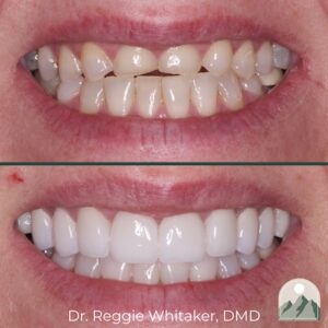 A before and after photo of porcelain veneers from Roy Dental Care.
