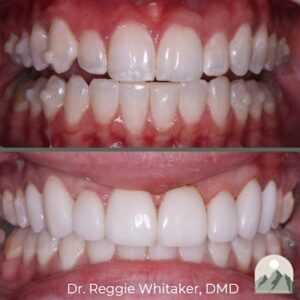 A before-and-after image of a Roy Dental Care patient who received porcelain veneers.