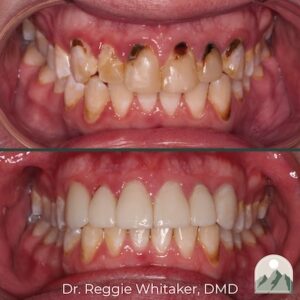 A before and after image of restorative dentistry treatment.