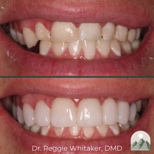 A patient of Roy Dental Care before and after cosmetic dental treatment.
