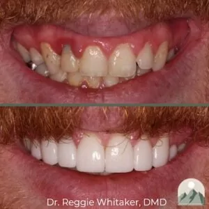 The before and after images of a Roy Dental Care cosmetic dentistry patient.