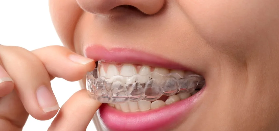 A woman inserting an invisable teeth aligner.