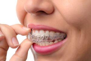 A woman inserting an invisable teeth aligner.